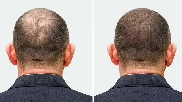 Antes e depois do transplante capilar sem barbear