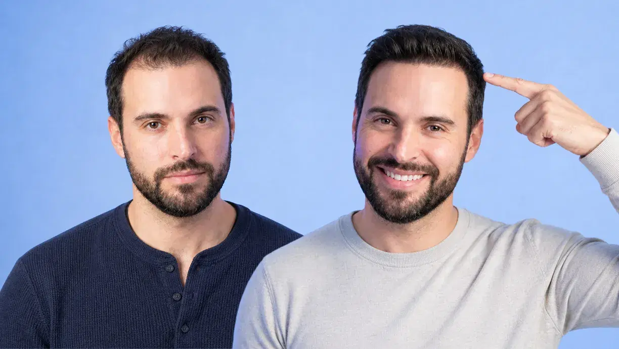 Antes e depois do transplante capilar sem barbear