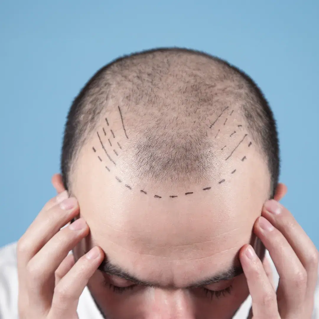Coisas A Considerar Antes Do Transplante De Cabelo