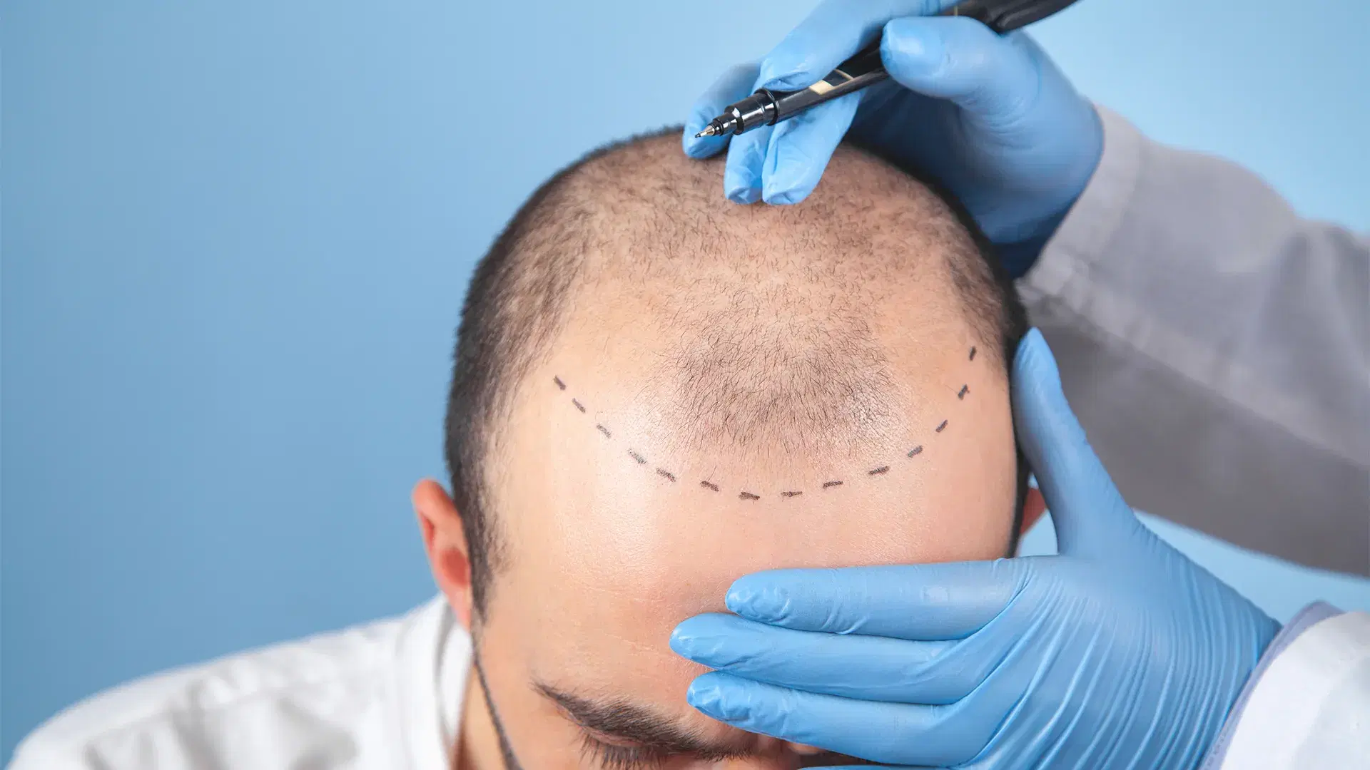 DHI Hair Transplant