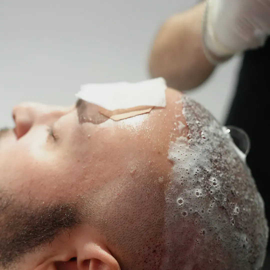 Lavagem De Cabelo Após Transplante Capilar Durante Os Primeiros Dez Dias