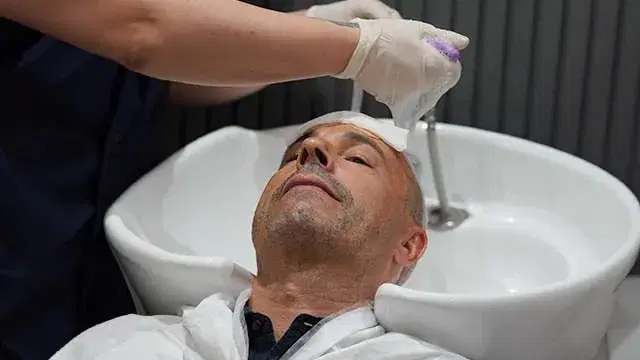 Lavagem De Cabelo Após Transplante Capilar Durante Os Primeiros Dez Dias