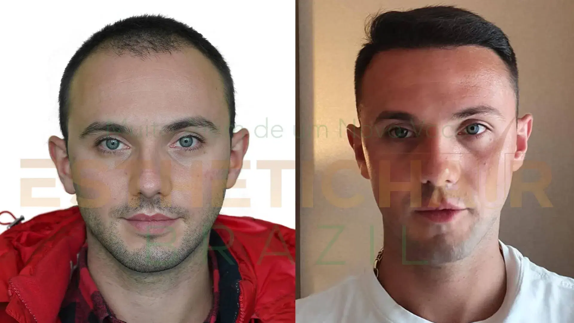 Vantagens do Transplante Capilar